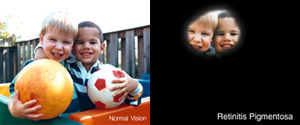 Retinitis Pigmentosa Versus Normal Vision